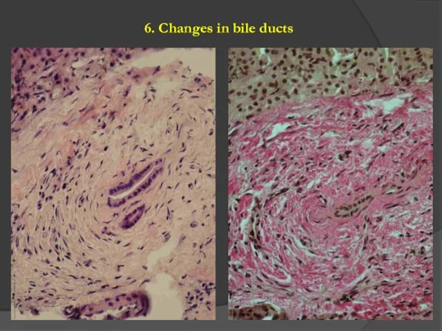 6. Changes in bile ducts