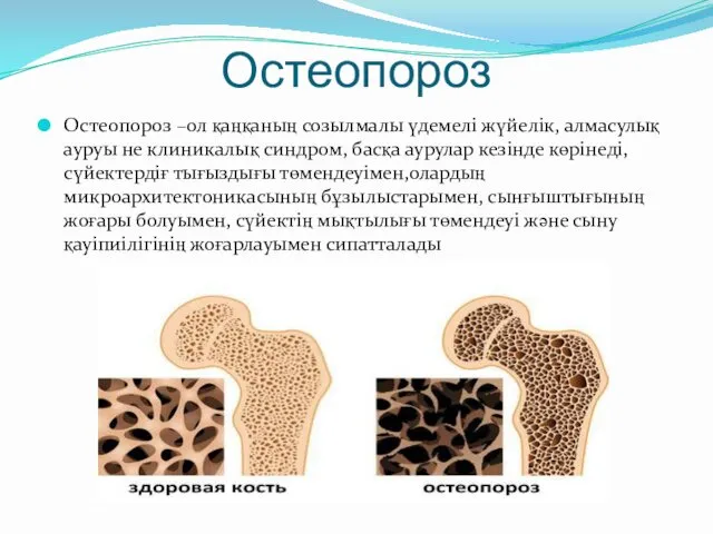 Остеопороз Остеопороз –ол қаңқаның созылмалы үдемелі жүйелік, алмасулық ауруы не