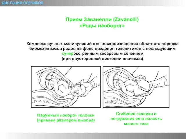 ДИСТОЦИЯ ПЛЕЧИКОВ Прием Заванелли (Zavanelli) «Роды наоборот» Комплекс ручных манипуляций для воспроизведения обратного