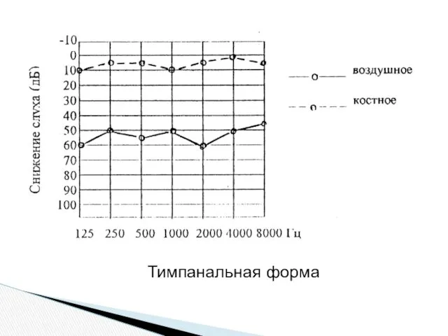 Тимпанальная форма