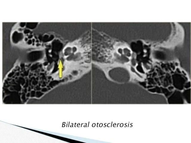 Bilateral otosclerosis