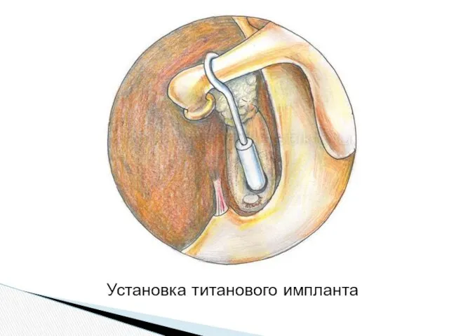 Установка титанового импланта