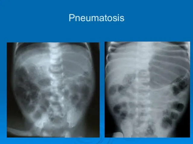 Pneumatosis