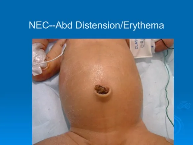 NEC--Abd Distension/Erythema