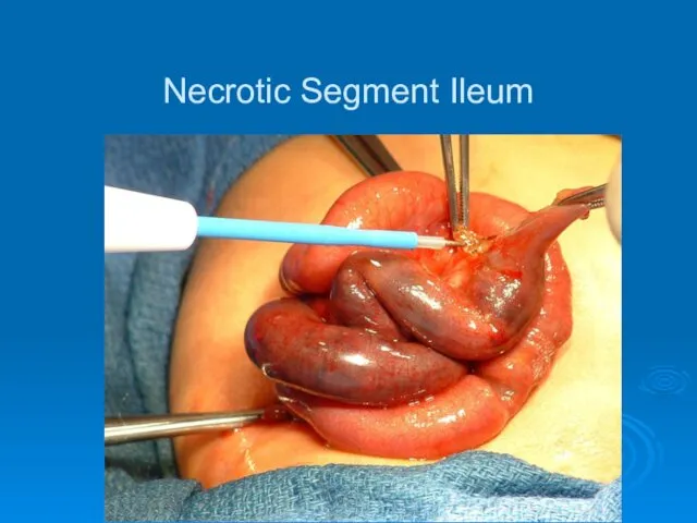Necrotic Segment Ileum