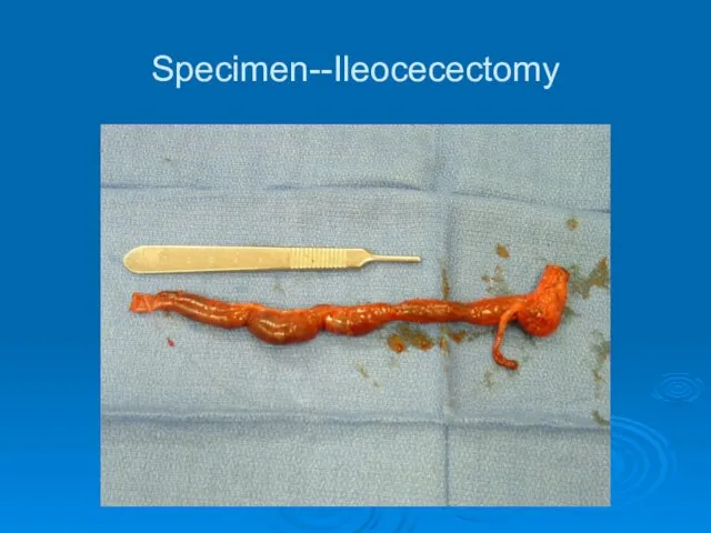 Specimen--Ileocecectomy