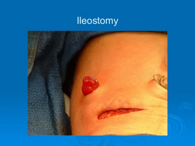 Ileostomy