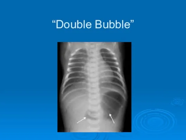 “Double Bubble”