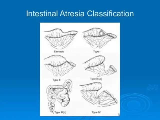 Intestinal Atresia Classification