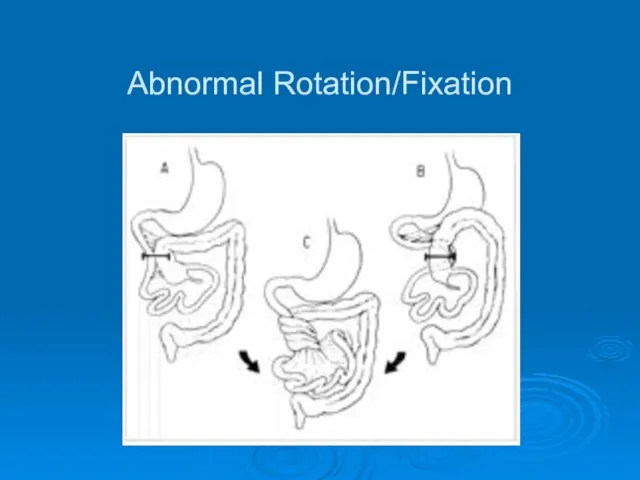 Abnormal Rotation/Fixation