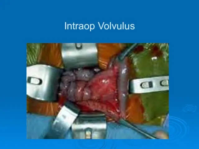 Intraop Volvulus