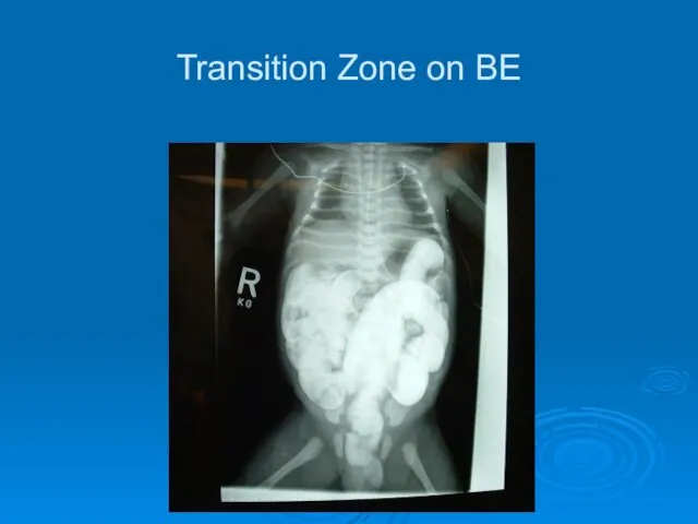 Transition Zone on BE