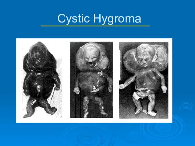 Cystic Hygroma