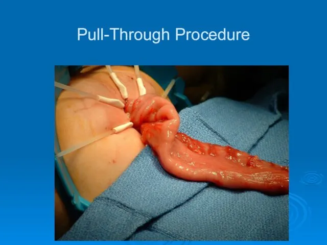 Pull-Through Procedure