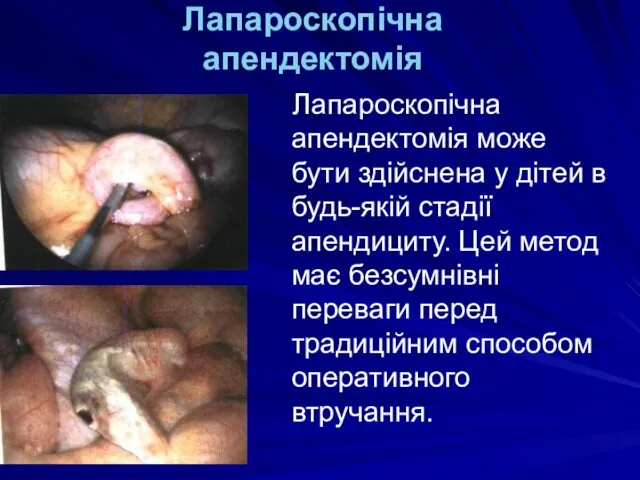 Лапароскопічна апендектомія Лапароскопічна апендектомія може бути здійснена у дітей в будь-якій стадії апендициту.