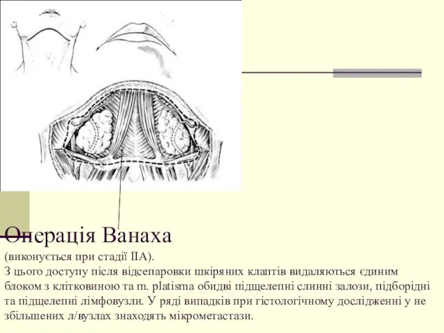 Операція Ванаха (виконується при стадії ІІА). З цього доступу після