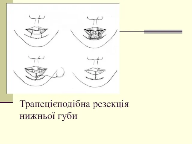 Трапецієподібна резекція нижньої губи