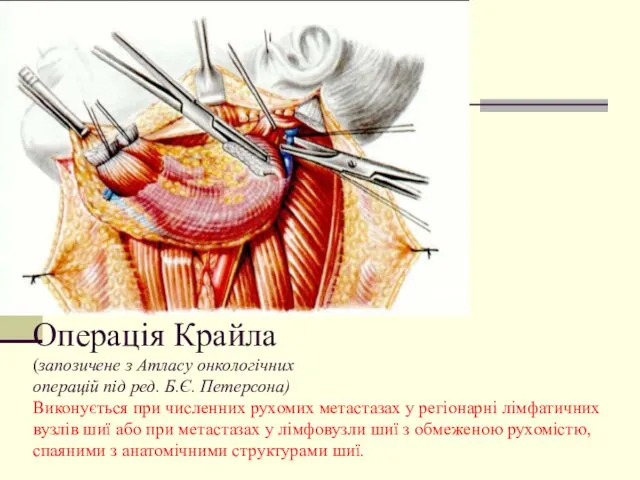 Операція Крайла (запозичене з Атласу онкологічних операцій під ред. Б.Є.