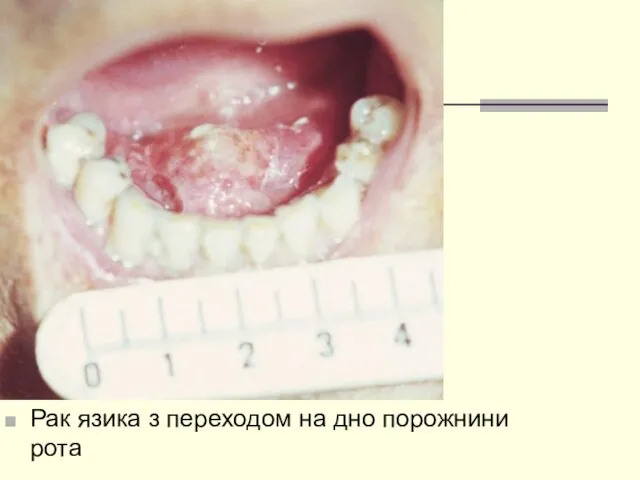 Рак язика з переходом на дно порожнини рота