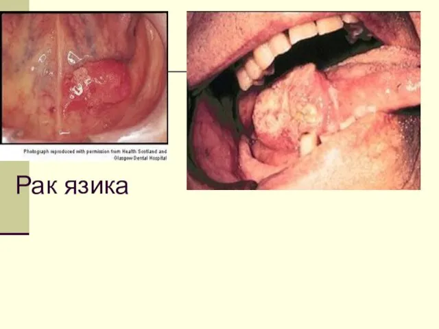 Рак язика