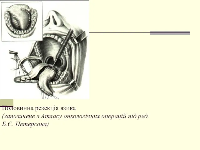 Половинна резекція язика (запозичене з Атласу онкологічних операцій під ред. Б.Є. Петерсона)