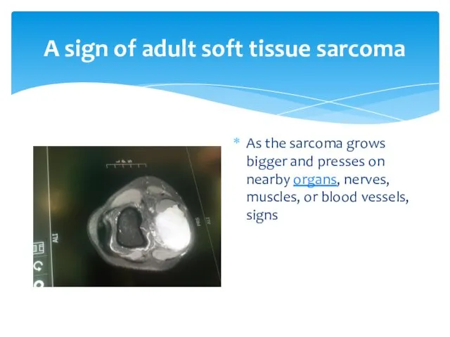 A sign of adult soft tissue sarcoma As the sarcoma grows bigger and