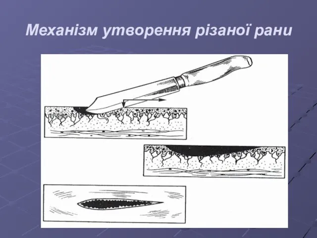 Механізм утворення різаної рани