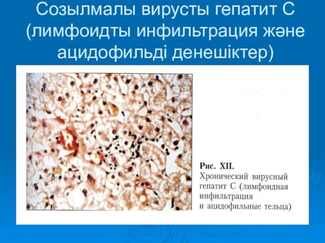 Созылмалы вирусты гепатит С(лимфоидты инфильтрация және ацидофильді денешіктер)