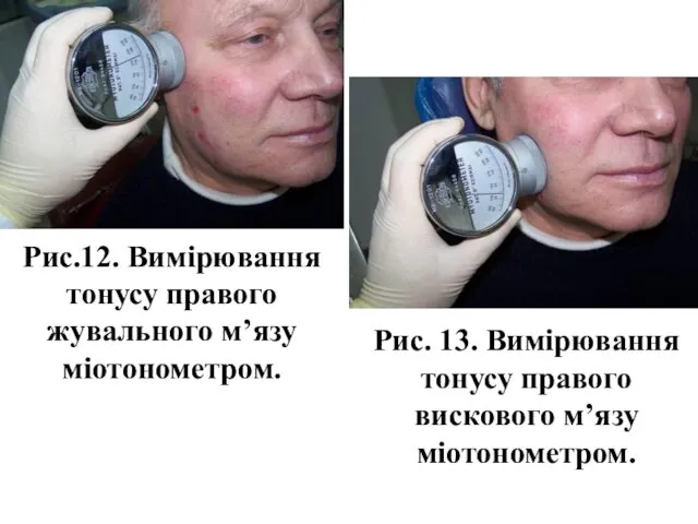 Рис.12. Вимірювання тонусу правого жувального м’язу міотонометром. Рис. 13. Вимірювання тонусу правого вискового м’язу міотонометром.