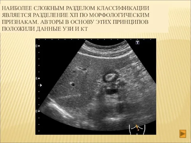 НАИБОЛЕЕ СЛОЖНЫМ РАЗДЕЛОМ КЛАССИФИКАЦИИ ЯВЛЯЕТСЯ РАЗДЕЛЕНИЕ ХП ПО МОРФОЛОГИЧЕСКИМ ПРИЗНАКАМ.