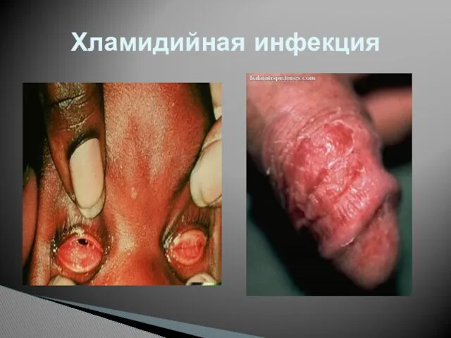 Хламидийная инфекция