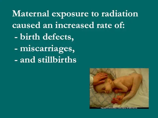 Maternal exposure to radiation caused an increased rate of: -