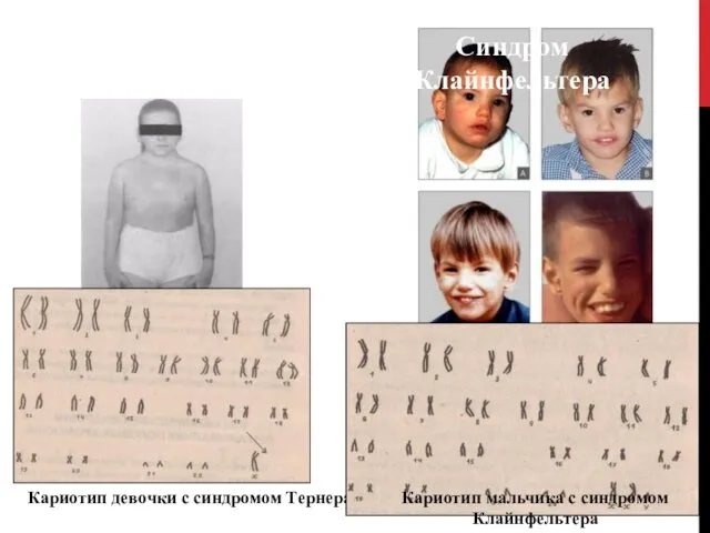 СИНДРОМ ШЕРИШЕВСКОГО -ТЕРНЕРА Синдром Клайнфельтера Кариотип девочки с синдромом Тернера Кариотип мальчика с синдромом Клайнфельтера