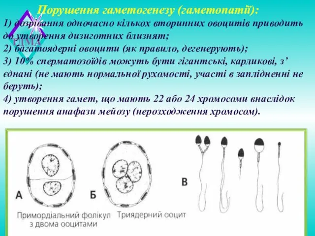 Порушення гаметогенезу (гаметопатії): 1) дозрівання одночасно кількох вторинних овоцитів приводить