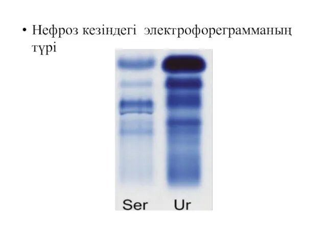Нефроз кезіндегі электрофореграмманың түрі