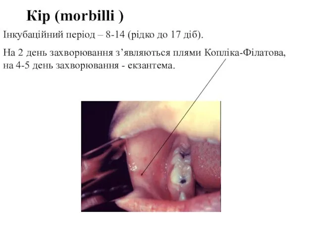 Кір (morbilli ) Інкубаційний період – 8-14 (рідко до 17