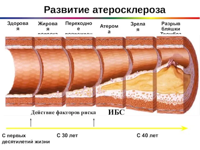 Развитие атеросклероза Здоровая артерия Жировая полоска Переходное повреждение Атерома Зрелая бляшка Разрыв бляшки