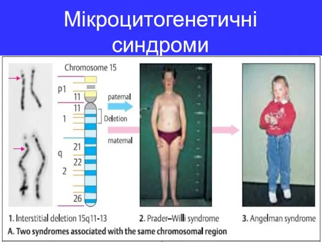 Мікроцитогенетичні синдроми