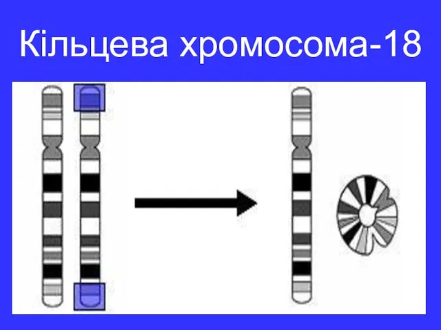Кільцева хромосома-18