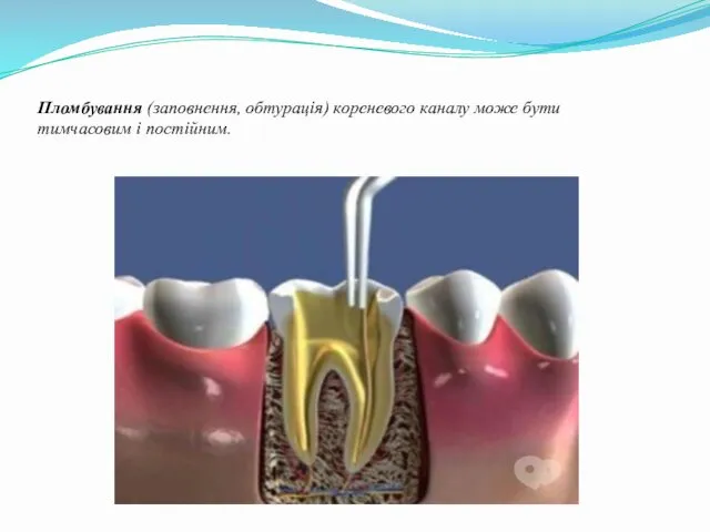 Пломбування (заповнення, обтурація) кореневого каналу може бути тимчасовим і постійним.