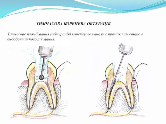 ТИМЧАСОВА КОРЕНЕВА ОБТУРАЦІЯ Тимчасове пломбування (обтурація) кореневого каналу є проміжним етапом ендодонтичного лікування.