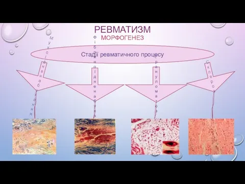 РЕВМАТИЗМ МОРФОГЕНЕЗ Стадії ревматичного процесу Мукоїдне набухання Фібриноїдне набухання Грануломатоз Склероз