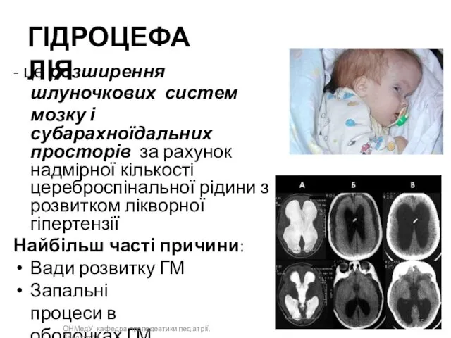 ГІДРОЦЕФАЛІЯ - це розширення шлуночкових систем мозку і субарахноїдальних просторів