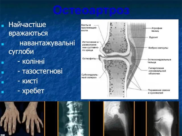 Остеоартроз Найчастіше вражаються навантажувальні суглоби - колінні - тазостегнові - кисті - хребет