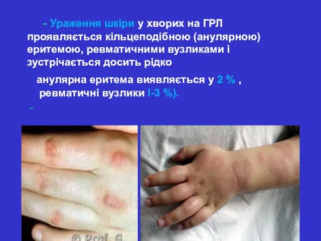 - Ураження шкіри у хворих на ГРЛ проявляється кільцеподібною (анулярною)