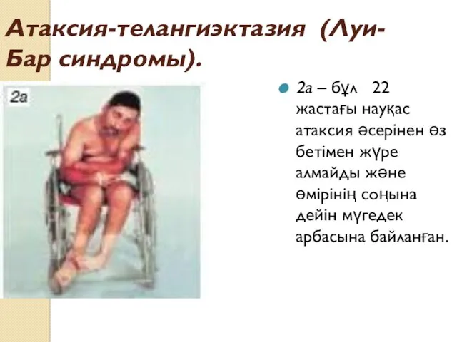 Атаксия-телангиэктазия (Луи-Бар синдромы). 2а – бұл 22 жастағы науқас атаксия