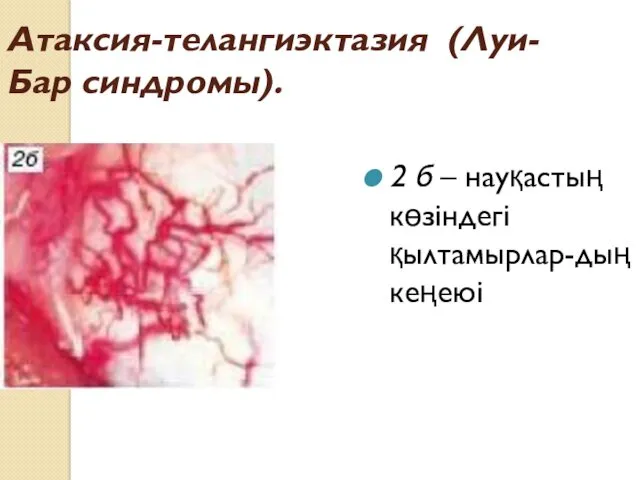 Атаксия-телангиэктазия (Луи-Бар синдромы). 2 б – науқастың көзіндегі қылтамырлар-дың кеңеюі