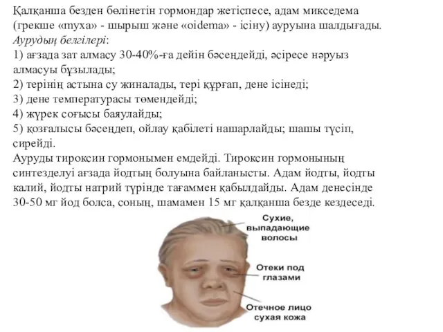 Қалқанша безден бөлінетін гормондар жетіспесе, адам микседема (грекше «myxa» -