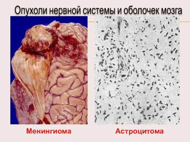 Опухоли нервной системы и оболочек мозга Менингиома Астроцитома