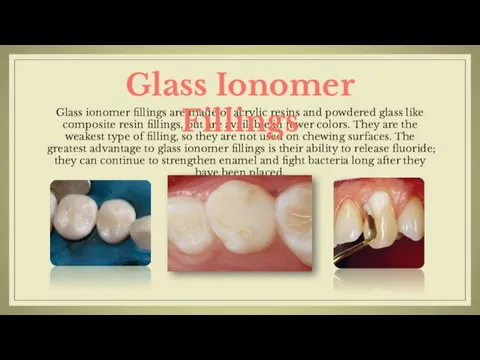 Glass ionomer fillings are made of acrylic resins and powdered